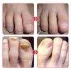 NailHelper Ingrowth Toenail Correction Treatment Oil